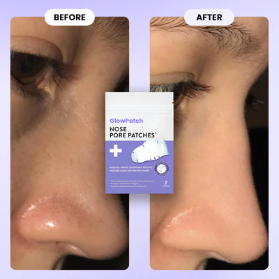 GlowPatch™ Pore Clearing Nose Patch